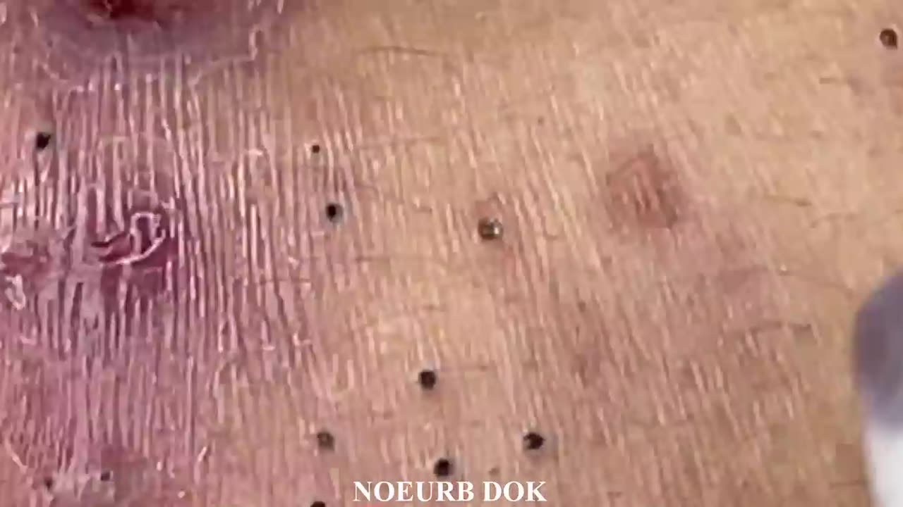 Popping Tons Of Blackheads