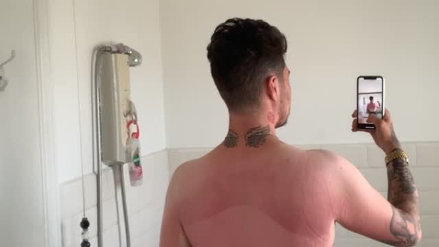 Man's Sunburn Looks Like Neapolitan Ice Cream