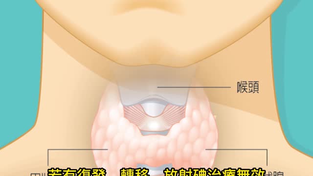 台灣甲狀腺癌成長95%! 無症狀如何及早發現?