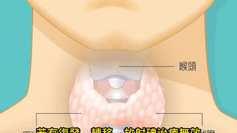 台灣甲狀腺癌成長95%！ 無症狀如何及早發現？