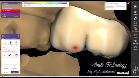 #design #naildesign #dental #dentaldesign #exocadexpert