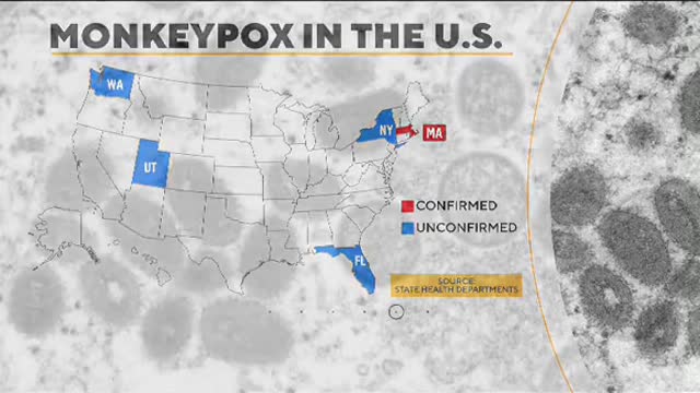 Growing concern over monkeypox in the U.S.
