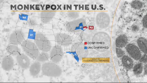 Growing concern over monkeypox in the U.S.