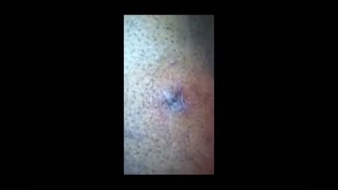 Satisfying explosive pImPLe PoPpING video | 4k (Gunk warning)