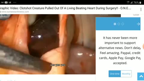 Graphic Video - pulling a clot shot creature out of a human heart