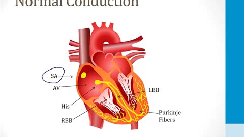 Cardiology - 4. Arrhythmias - 4.AVNRT