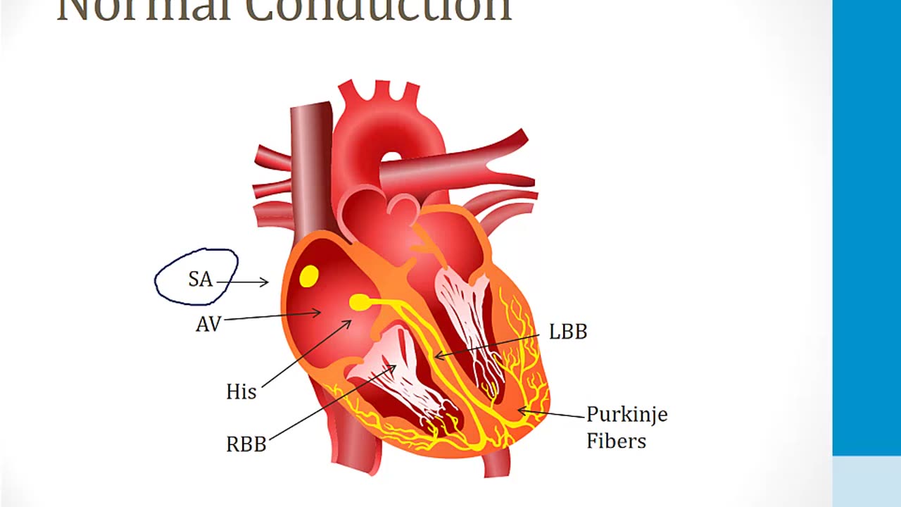 Cardiology - 4. Arrhythmias - 4.AVNRT