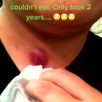 Newest pimple removal 2022 - Cystic acne extractions whiteheads new