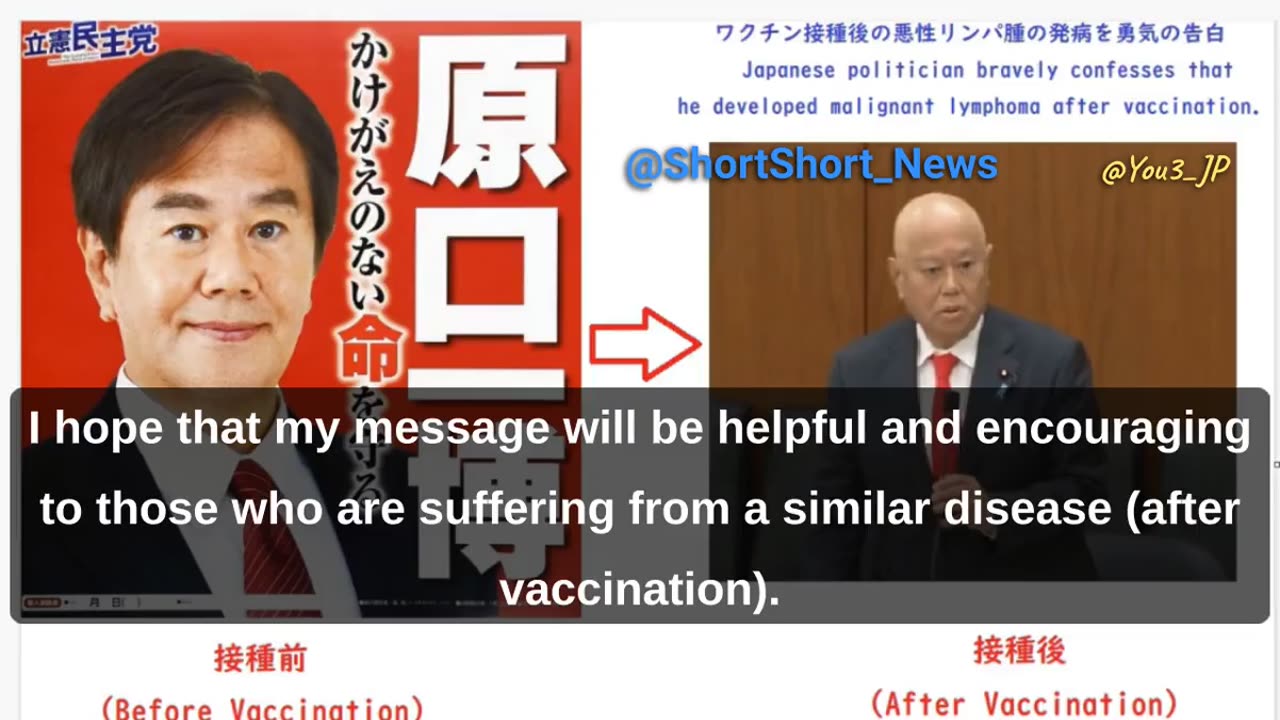 “日本Japan 新冠實驗針劑受害者_真相揭露”前國會議員_原口一博公開受訪，原本健康的自己在接種後立刻突發“惡性淋巴瘤”…