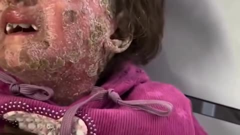 Girl denied medical treatment in Gaza