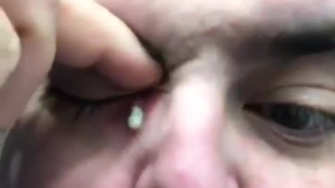 New Squirting Puss Eye Ball