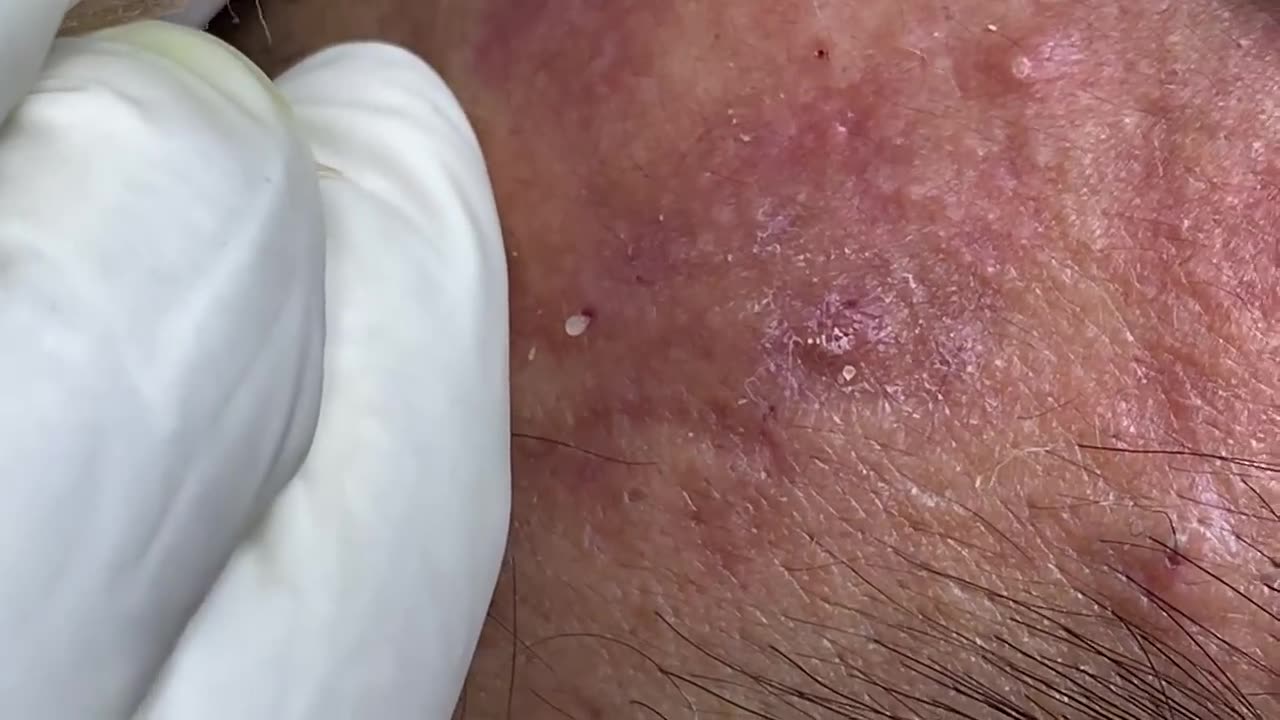 Big Cystic Acne