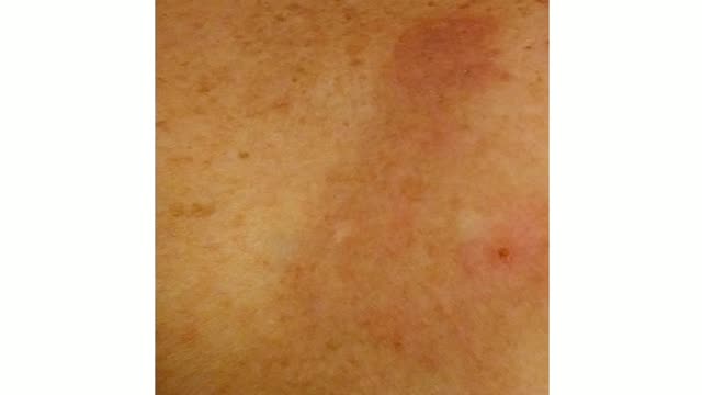 Treating a Giant Basal Cell Carcinoma with Curaderm BEC5