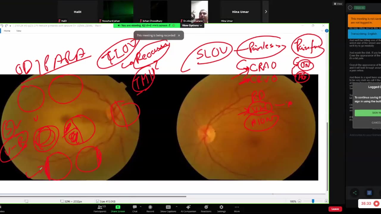 ST5.28 year old Lady with visual loss, BP 160