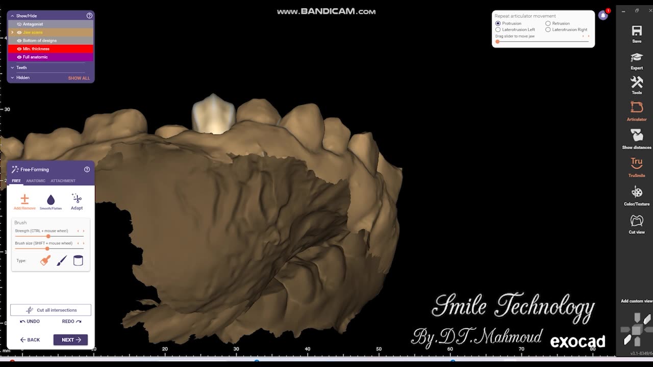 #design #naildesign #dental #dentaldesign #exocadexpert