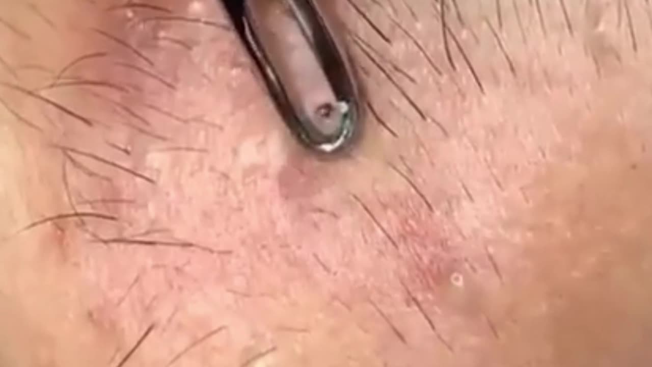 dr pimple popper best videos youtube blackheads removal