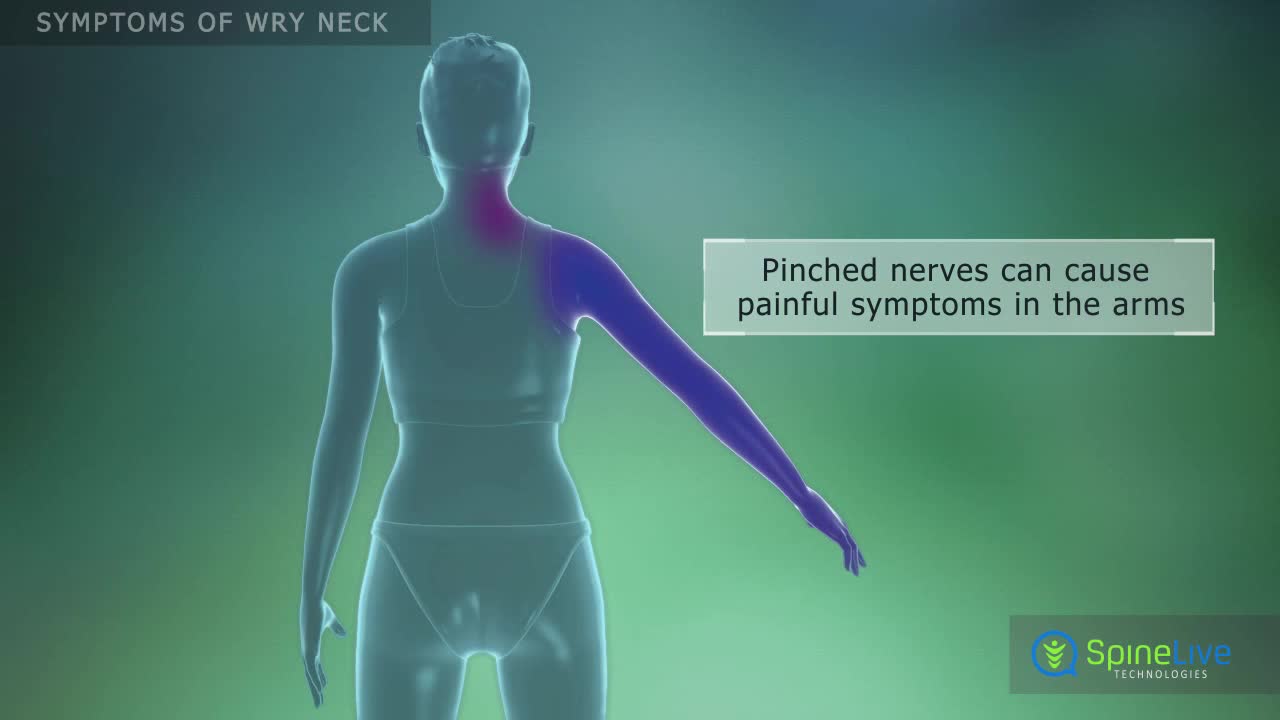 Wry Neck Symptoms