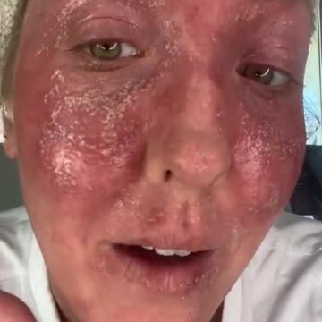 תופעת לוואי פגיעות בעור אחרי חיסון