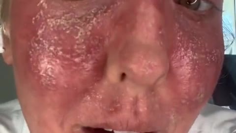 תופעת לוואי פגיעות בעור אחרי חיסון