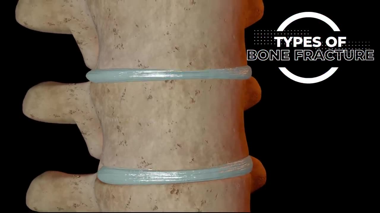 Common types of Bone fracture | 3D animation |