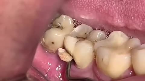 dental treatment