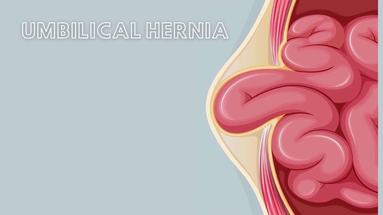 Large Intestine and Umbilical Hernias