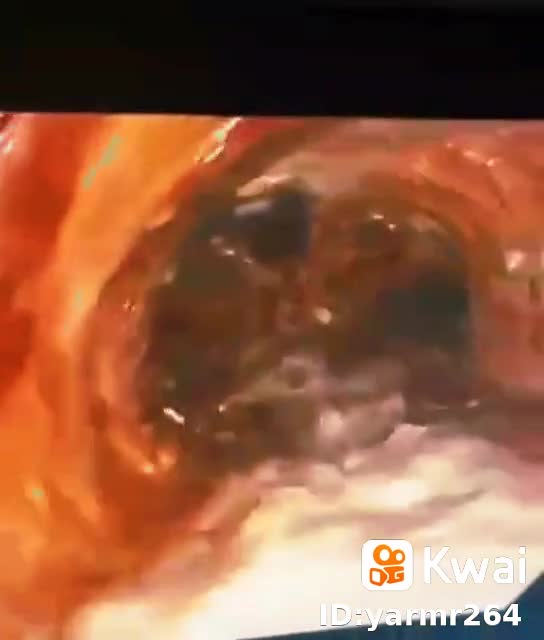 ¡¡BOMBA!! SALE A LA LUZ UNA ENDOSCOPÍA QUE DEMUESTRA DAÑOS POR INYECCIÓN COVID