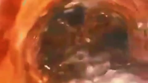 ¡¡BOMBA!! SALE A LA LUZ UNA ENDOSCOPÍA QUE DEMUESTRA DAÑOS POR INYECCIÓN COVID