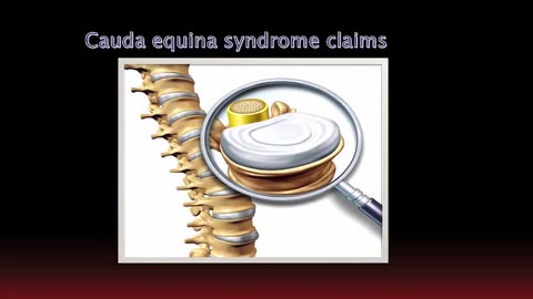 What exactly is Cauda Equina Syndrome ?