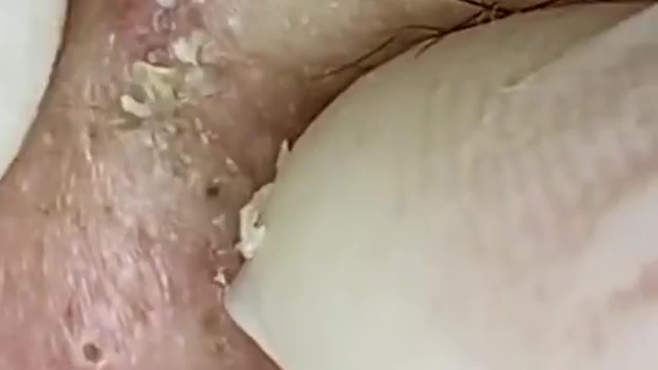 Pimple Popping - Acne Treatment - Blackhead Extraction