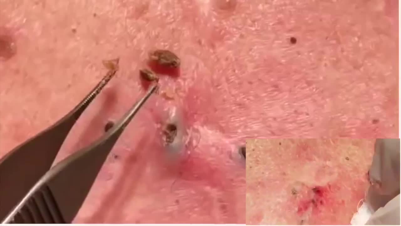 Satisfying Video Acne, Blackheads Removal