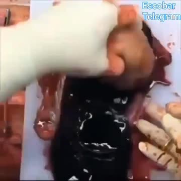 MÉDICO MOSTRA ÓRGÃO DE UMA PESSOA QUE APLICOU A DOSE