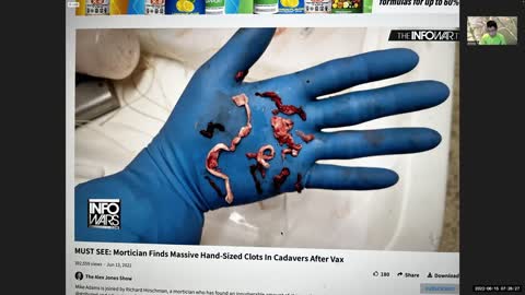 強尼大哥 疫苗短片 恐怖的血栓