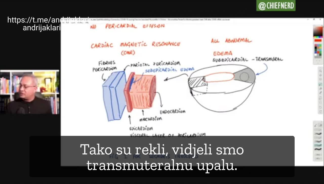 Miokarditisi i perikarditisi kod djece