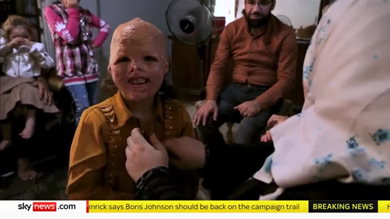 Turkey- Syrian girl burnt in tent fire beating the odds - but mum says 'she's shunned by society