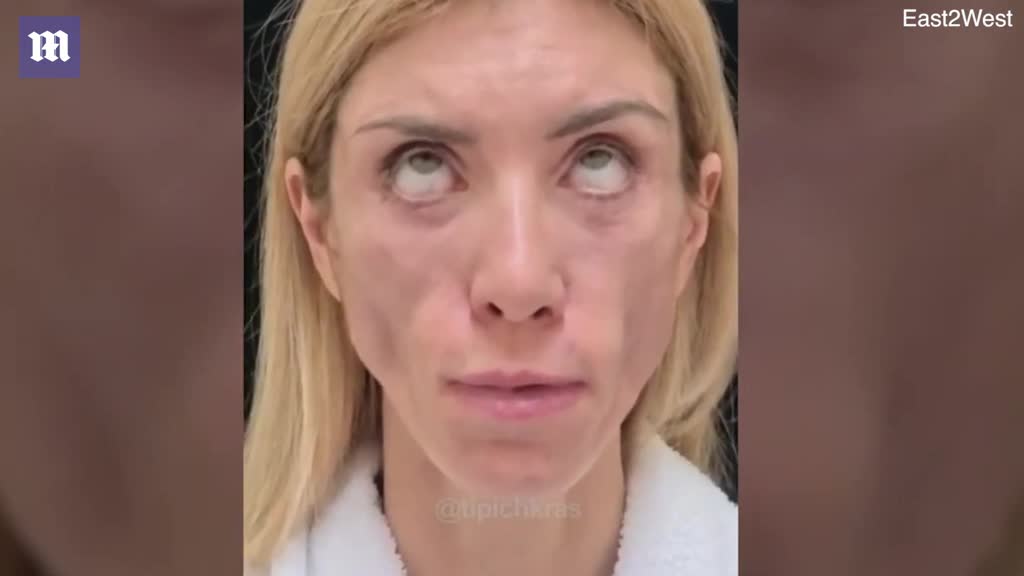 Shocking before and after of Russian beauty queen's botched surgery