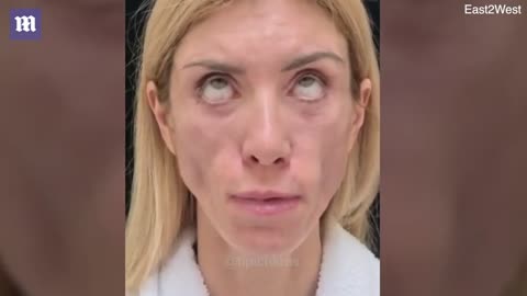 Shocking before and after of Russian beauty queen's botched surgery