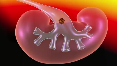 Kidney Stone Treatments