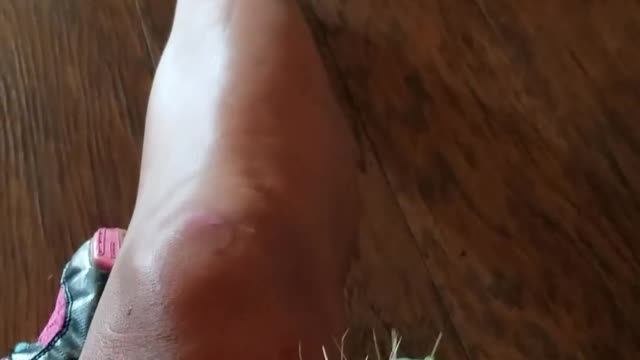 Spiky Cactus Stuck in Leg