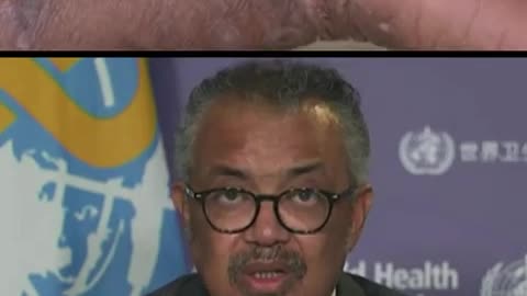 Tedros WHO World Health Organization MPOX Global Health Emergency