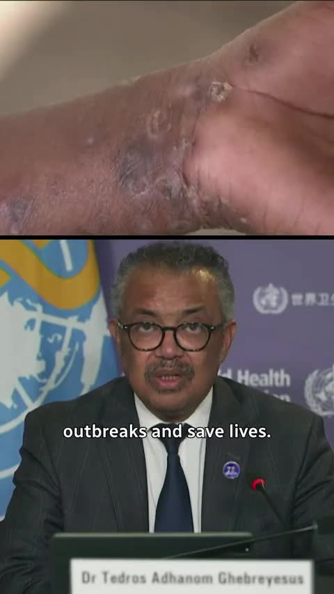 Tedros WHO World Health Organization MPOX Global Health Emergency