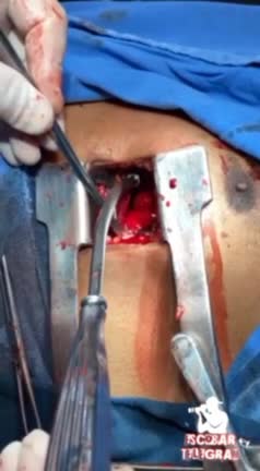 Operação cardíaca mostrando os trombos após vaxxinação