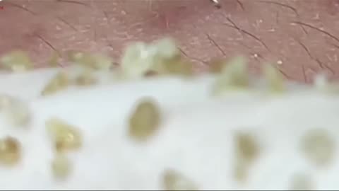 Satisfying Whiteheads extaction!