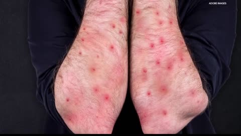Indiana monkeypox cases on the rise