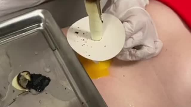 They used a egg to clean out her belly button…