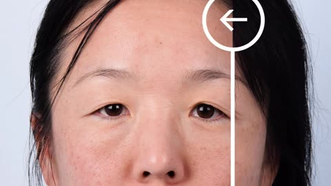 Double Eyelid Surgery: Transforming Hooded Eyelids for a Brighter, Youthful Look