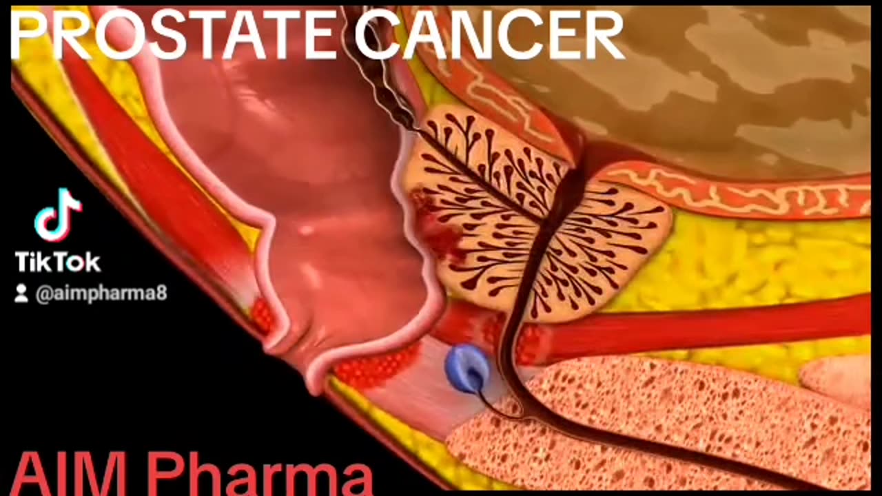 Prostate cancer animation #2023