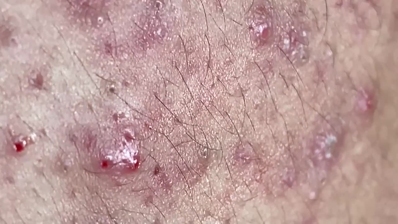 Acne Treatment Huong Da Nang#001 MEMBER