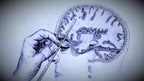 The Dark side of Science: The Lobotomy, the worst surgery in history? (Documentary)