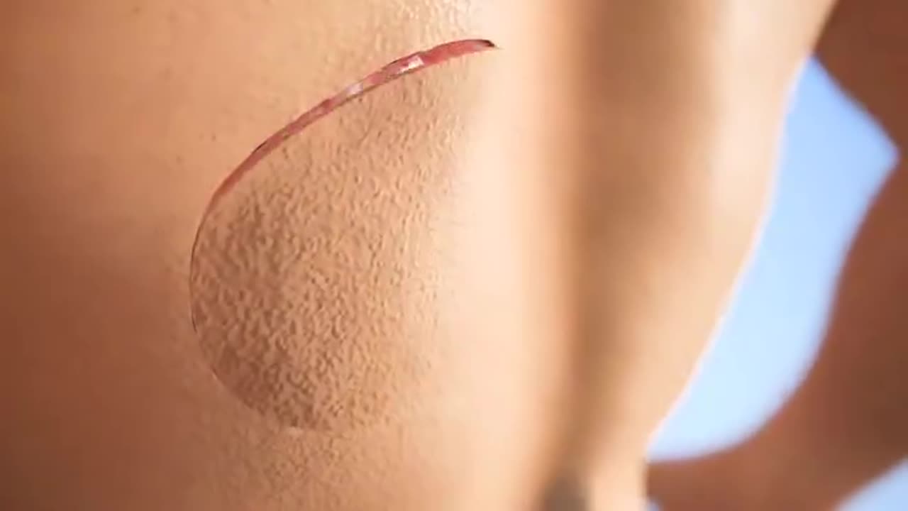 How Skin Grafts Are Done